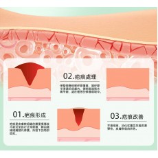 矽膠去疤修復貼 祛疤膏貼 袪疤貼(4cm x 1.5m)疤痕隱藏貼 自由裁剪祛疤貼 祛疤膏貼 剖腹產疤痕貼
