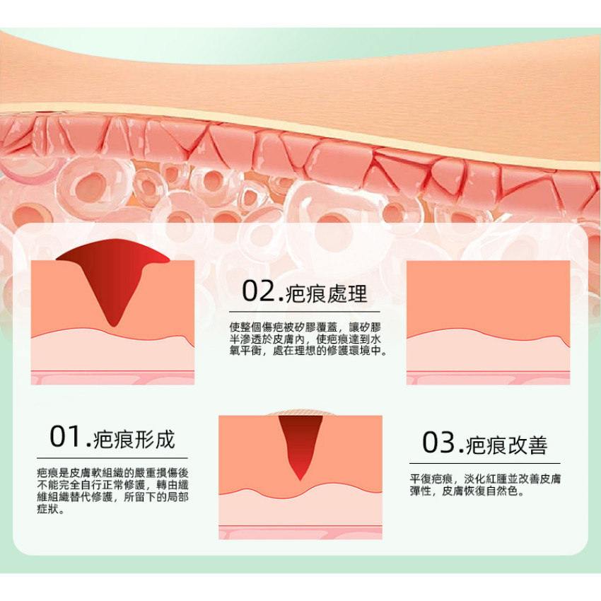 矽膠去疤修復貼 祛疤膏貼 袪疤貼(4cm x 1.5m)疤痕隱藏貼 自由裁剪祛疤貼 祛疤膏貼 剖腹產疤痕貼