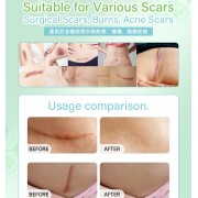 矽膠去疤修復貼 祛疤膏貼 袪疤貼(4cm x 1.5m)疤痕隱藏貼 自由裁剪祛疤貼 祛疤膏貼 剖腹產疤痕貼