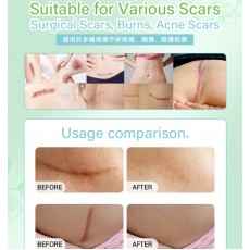 矽膠去疤修復貼 祛疤膏貼 袪疤貼(4cm x 1.5m)疤痕隱藏貼 自由裁剪祛疤貼 祛疤膏貼 剖腹產疤痕貼