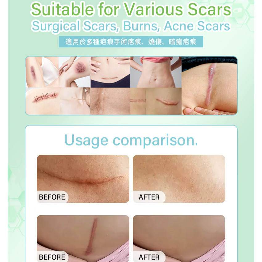 矽膠去疤修復貼 祛疤膏貼 袪疤貼(4cm x 1.5m)疤痕隱藏貼 自由裁剪祛疤貼 祛疤膏貼 剖腹產疤痕貼