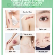 矽膠去疤修復貼 祛疤膏貼 袪疤貼(4cm x 1.5m)疤痕隱藏貼 自由裁剪祛疤貼 祛疤膏貼 剖腹產疤痕貼